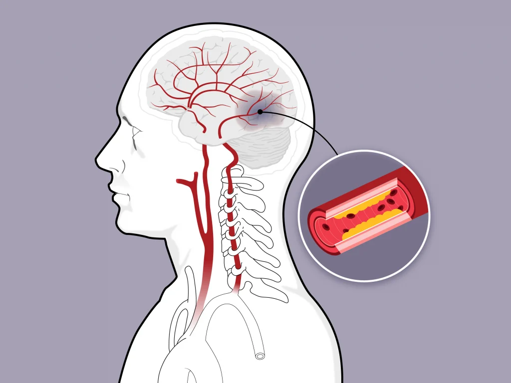 Що таке інсульт: типи, симптоми, фактори ризику